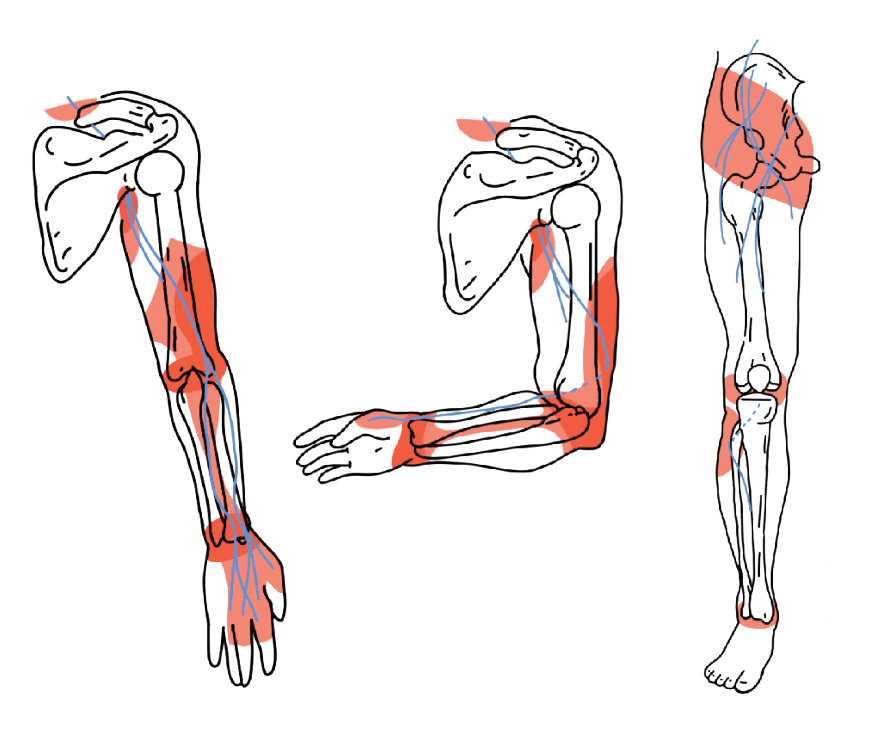 diagrama de los nervios en el brazo